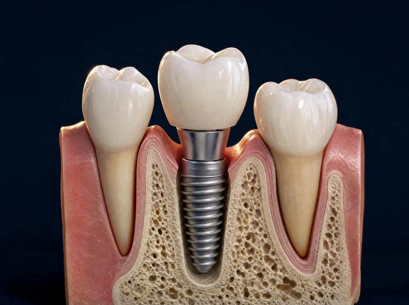 Ilustração em corte de um implante dentário com coroa entre dois dentes naturais