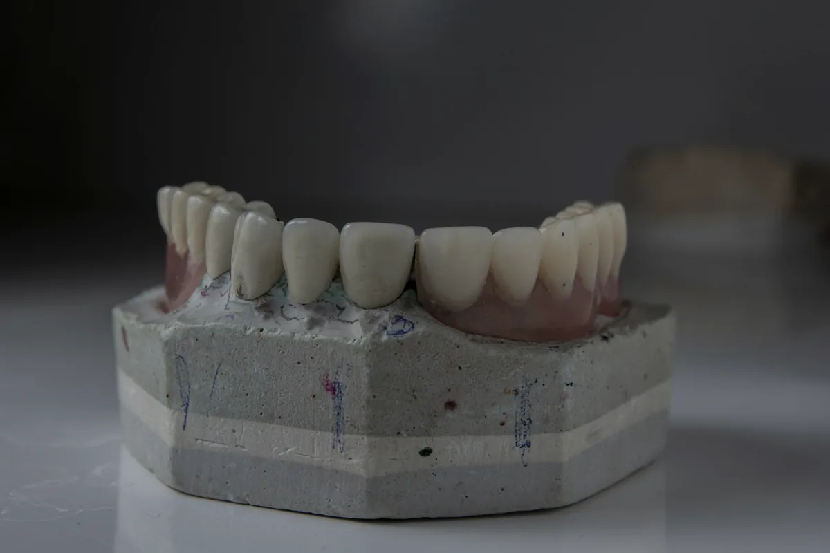 Prótese de arcada inteira montada sobre modelo de gesso