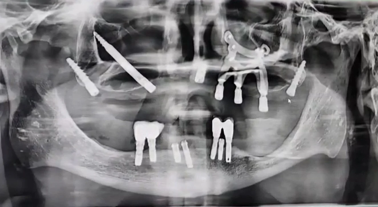 Radiografia panorâmica de uma maxila reabilitada com implantes zigomáticos e convencionais